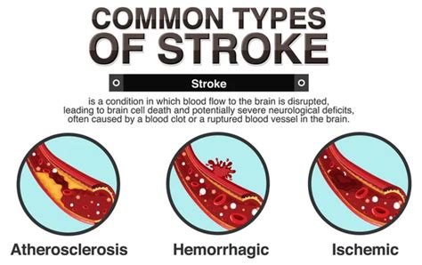 Informative Poster Cerebrovascular Stroke Illustration Stock Vector By ©blueringmedia 650652464