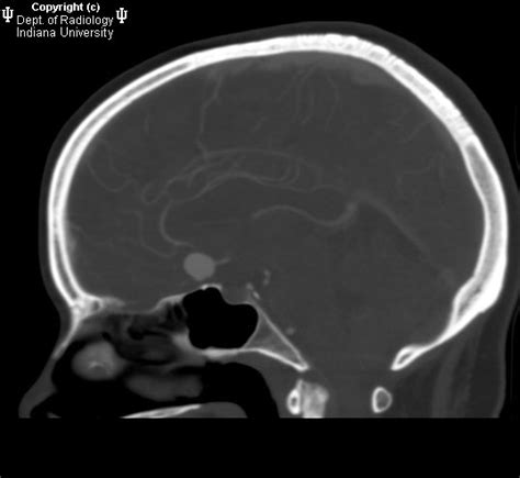 Neuroradiology On the Net: Anterior communicating artery aneurysm