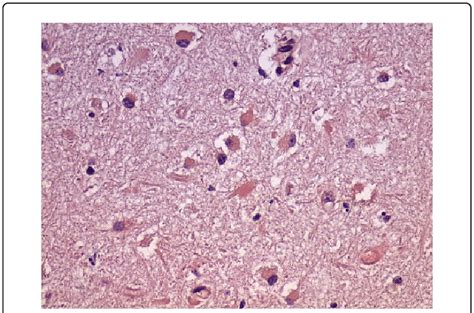 Alzheimer's disease hippocampus, Positive staining is noted in the ... 
