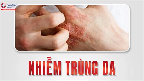 Tyrothricin: Kháng sinh tại chỗ phổ rộng phân lập từ Bacillus brevis