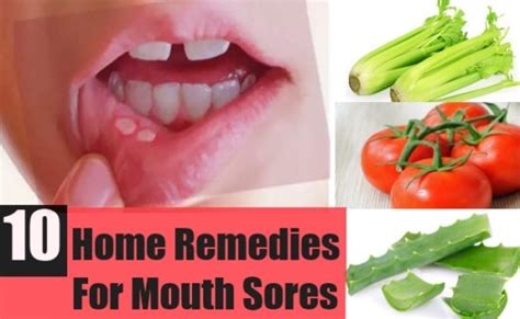 Home Remedies for Mouth Sores, Causes, How to Cure Mouth Sores