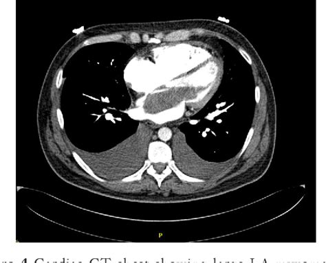 Figure 4 From Minimally Invasive Resection Of Benign Cardiac Tumors Semantic Scholar