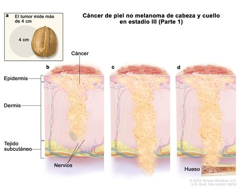 Tratamiento Del Cáncer De Piel Nci