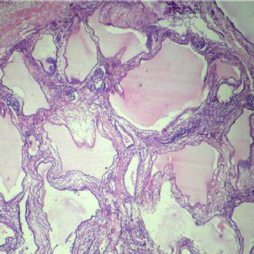 External examination - Female baby with bilateral club feet and ...