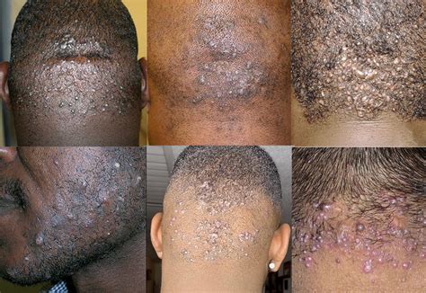 Ingrown Hair Treatment Understanding And Managing The Issue Barber Bumps Store