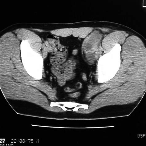 Retroperitoneal Lymph Node Dissection Download Scientific Diagram