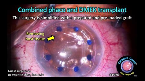 Cataractcoach Combined Phaco And Dmek Corneal Transplant Youtube