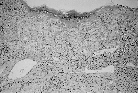 Figure 2 From A Case Of Giant Extramammary Paget’s Disease Of The Genital Area With Squamous