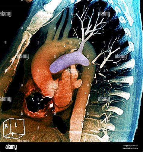 Tomografía computarizada TC en 3D de color del tórax de un paciente