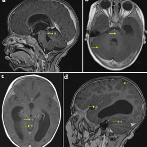 Axial And Sagittal Sections Of A Brain Mri In T Sequence After