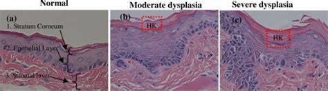 Cross Sectional H E Sections Of Normal A Moderate Dysplasia B And