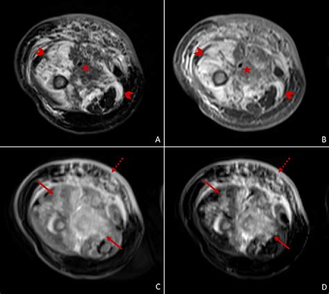 Magnetic Resonance Imaging Of The Right Thigh Axial T2 Weighted Image