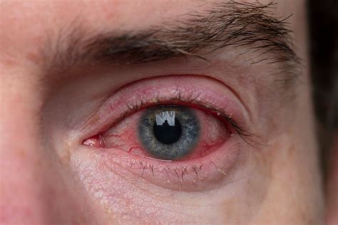 Understanding Corneal Eye Ulcers: Causes, Symptoms, and Treatment