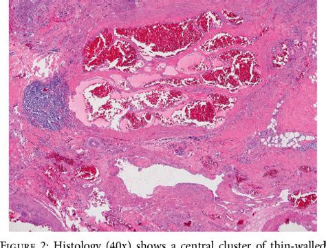 [PDF] Case Report of Fibro-Adipose Vascular Anomaly (FAVA) with ...