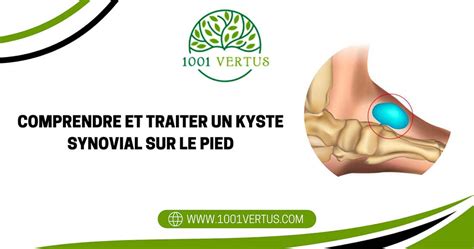 Kyste Synovial Sur Le Pied Le Guide Pratique Sur Le Sujet