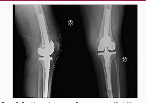 Indications And Results Of Condylar Constrained Implant In Primary