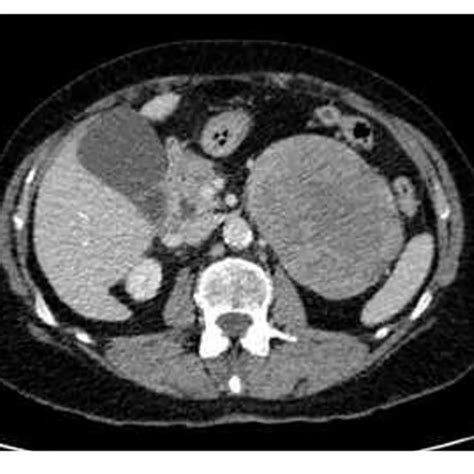 | CT-scan of the abdomen. Axial CT scan of the abdomen reveals a large ...