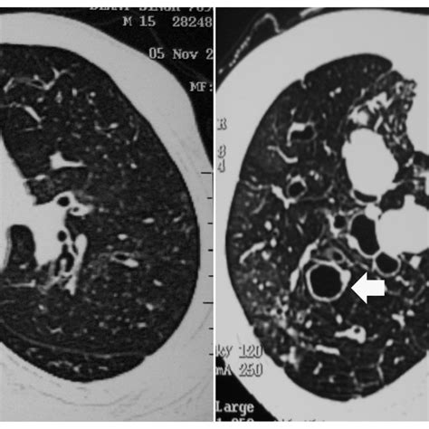 Presence Of Central Bronchiectasis In Two Different Patients With Download Scientific Diagram