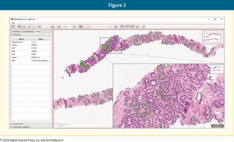 Artificial Intelligence And Prostate Cancer Diagnosis And Grading