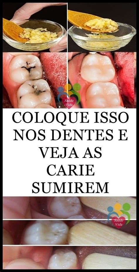 Cárie Dentária Nunca Mais Remédio Caseiro ⭐⭐⭐⭐⭐ 55 Cárie