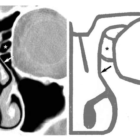 (Left) A coronal CT scan illustrating the agger nasi cell (*) and ...