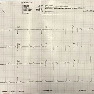 ECG shows sinus rhythm with ST-T changes in leads V1 to V4 | Download ...