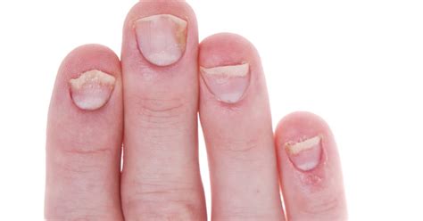 What causes pitted fingernails - Awesome Nail