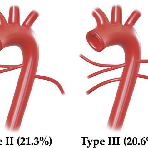 The most common anatomical variations of the bronchial arteries with ...