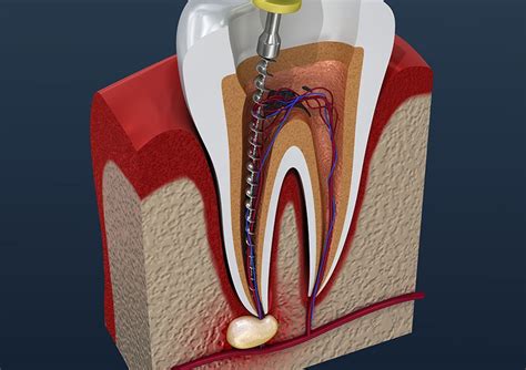 Endodontics Dr Joan S Specialists Dental Clinic