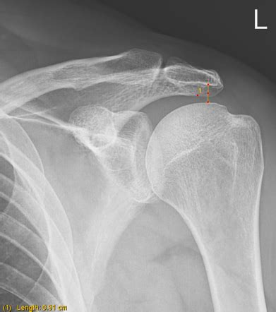 subacromial joint space radiology