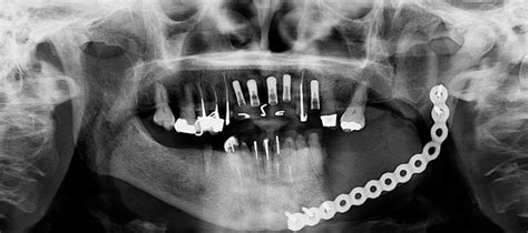 Osteonecrosis En La Colocaci N De Implantes Dentales Originado Por