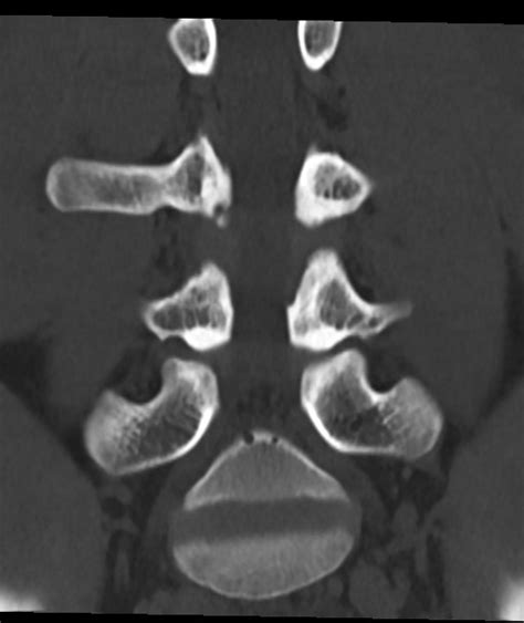 Pars Interarticularis Defects Multilevel Image