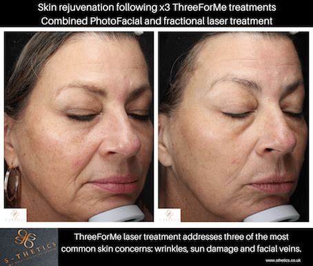 Patient Success Story Combination Laser Treatment For Skin