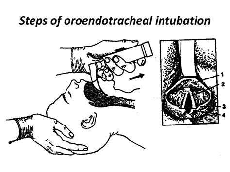 PPT - ENDOTRACHEAL INTUBATION PowerPoint Presentation, free download ...