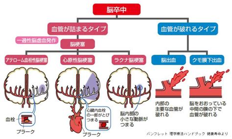 脳卒中について 備後脳卒中ネットワーク