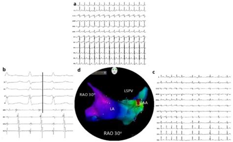 A 12 Lead Ecg Of Baseline Tachycardia Suggestive Of High Left Atrial Download Scientific