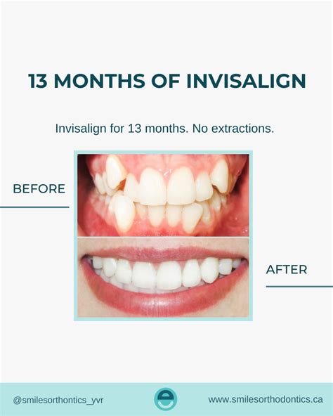 Invisalign Before And After Smiles Orthodontics