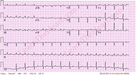 Atrial Tachycardia With 21 Av Block Ecg Example 1 Learn The Heart