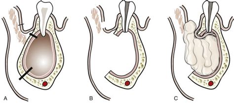 The Ranula Chronicles: Time to Marsupialize, aka Surgery #2 — Sarah Kay Youny Lee DDS, MS, FACP