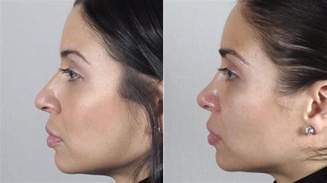 Rhinoplasty Before And After Pictures Case 172 Paramus NJ Parker