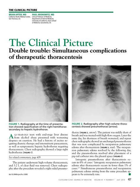 Double Trouble Simultaneous Complications Of Therapeutic Thoracentesis