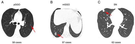 High Resolution Computed Tomography Was Used To Evaluate Patients With