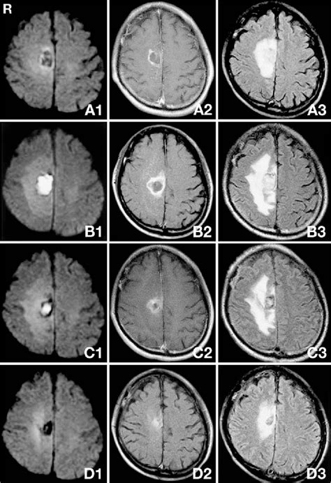 Figure 1 From Detection And Characterization Of The Evolution Of Cerebral Abscesses With