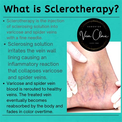 Sclerotherapy For Varicose And Spider Vein Treatment Edmonton Vein Clinic