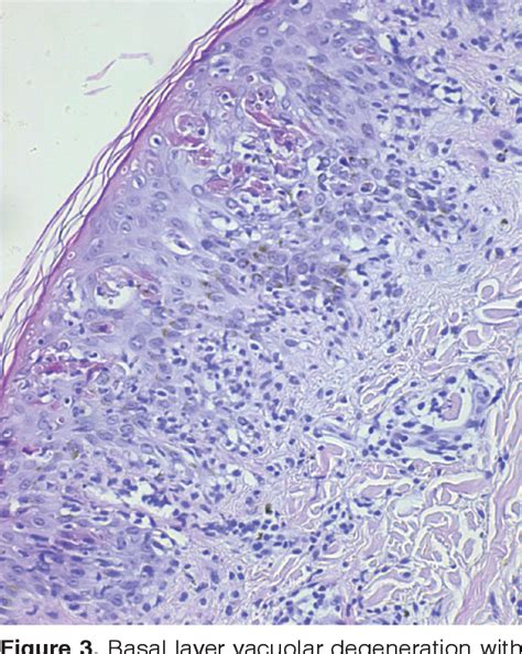 Figure 1 From Toxic Epidermal Necrolysis Like Subacute Cutaneous Lupus