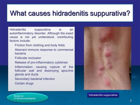 Hidradenitis Suppurativa By Dr Mohammad Baghaei Ppt