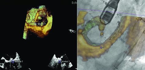 Fusion Of 3 Dimensional Echocardiography With Fluoroscopy Using