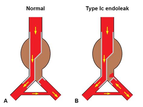 Type Ic Endoleak A Normal Aspect After Evar With An Aortouniliac