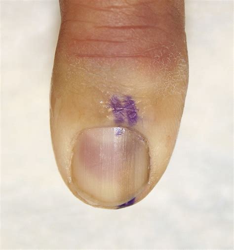 Nail Matrix Biopsy Of Longitudinal Melanonychia Diagnostic Algorithm