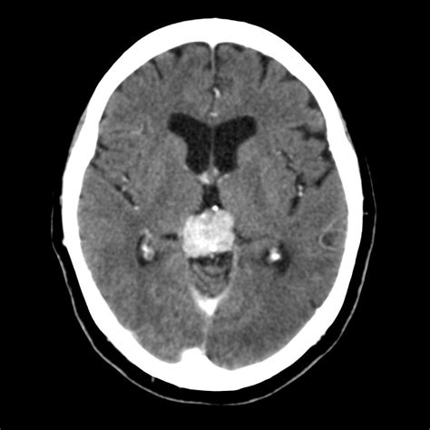 Pineal tumor - histology unknown | Image | Radiopaedia.org